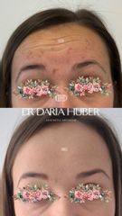 Toksyna botulinowa - zmarszczki poziome czoła