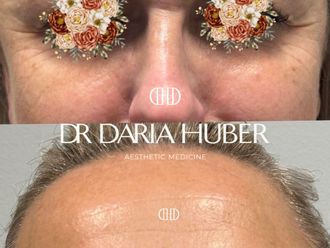 Toksyna botulinowa przed i po - 877430