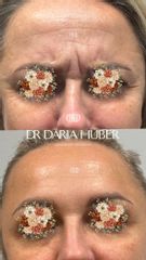 Toksyna botulinowa - „lwia zmarszczka”