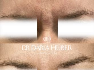 Toksyna botulinowa przed i po - 877439