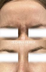 Toksyna botulinowa - „lwia zmarszczka” 1