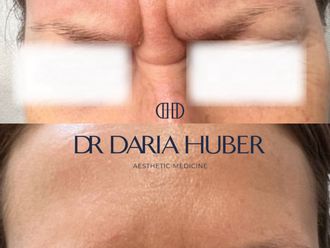 Toksyna botulinowa przed i po - 877440