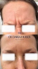 Toksyna botulinowa - „lwia zmarszczka”