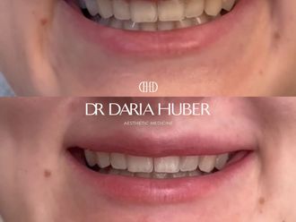 Toksyna botulinowa przed i po - 877472