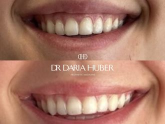 Toksyna botulinowa przed i po - 877473