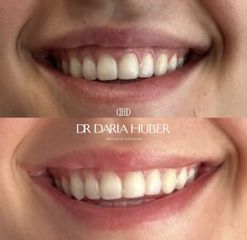 Zmniejszenie widoczności uśmiechu dziąsłowego tzw. „gummy smile”