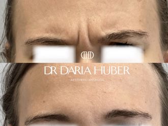 Toksyna botulinowa przed i po - 877474