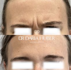 Toksyna botulinowa - „lwia zmarszczka”