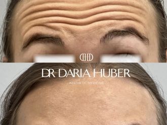 Toksyna botulinowa przed i po - 877475