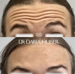 Toksyna botulinowa - zmarszczki poziome czoła