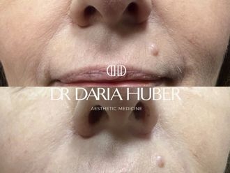 Kwas hialuronowy przed i po - 877476