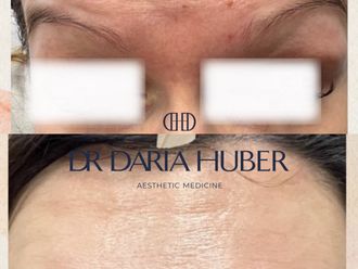 Toksyna botulinowa przed i po - 877477