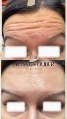 Toksyna botulinowa - zmarszczki poziome czoła