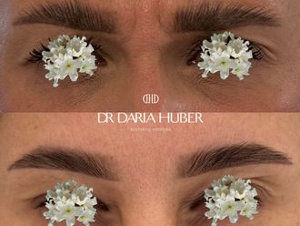 Toksyna botulinowa przed i po - 877515