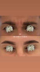 Toksyna botulinowa - „lwia zmarszczka”