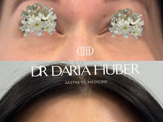 Toksyna botulinowa przed i po - 877516