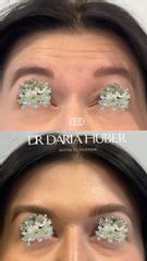 Toksyna botulinowa - zmarszczki poziome czoła