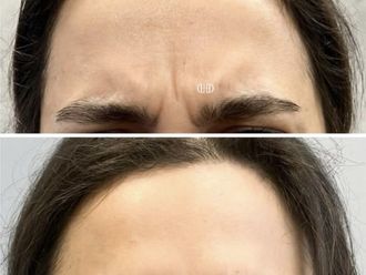 Toksyna botulinowa przed i po - 877517