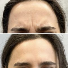 Toksyna botulinowa - „lwia zmarszczka”