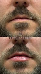 Modelowanie ust pierwszorazowe