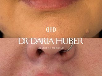 Powiększanie ust przed i po - 877520