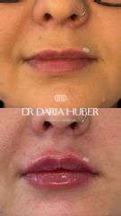 Modelowanie ust kwasem hialuronowym