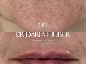 Powiększanie ust przed i po - 877521