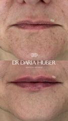 Modelowanie ust kwasem hialuronowym