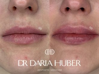 Powiększanie ust przed i po - 877522