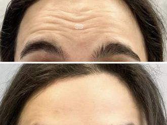 Toksyna botulinowa przed i po - 877523