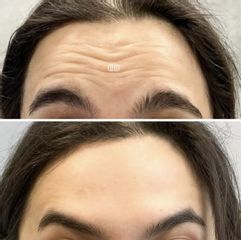 Toksyna botulinowa - zmarszczki poziome czoła