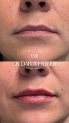 Modelowanie ust kwasem hialuronowym