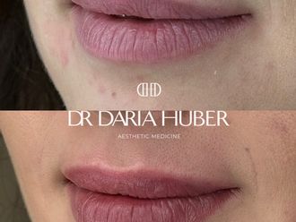 Powiększanie ust przed i po - 877525