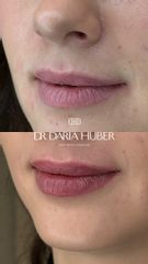 Modelowanie ust kwasem hialuronowym