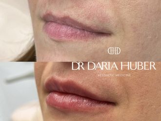 Powiększanie ust przed i po - 877526