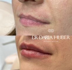 Modelowanie ust kwasem hialuronowym