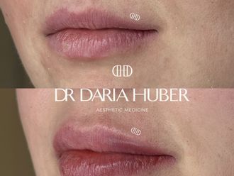 Powiększanie ust przed i po - 877527