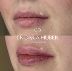 Modelowanie ust kwasem hialuronowym