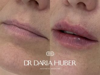 Powiększanie ust przed i po - 877528