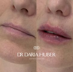 Modelowanie ust kwasem hialuronowym