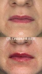 Modelowanie ust kwasem hialuronowym