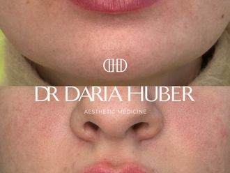 Powiększanie ust kwasem hialuronowym przed i po - 877531