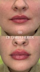 Modelowanie ust kwasem hialuronowym