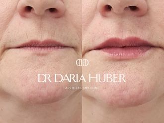 Powiększanie ust kwasem hialuronowym przed i po - 877532