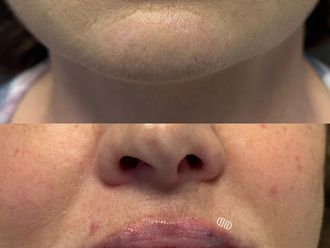 Powiększanie ust przed i po - 877534