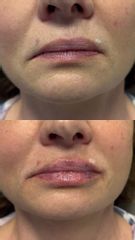 Pierwotne modelowanie ust kwasem hialuronowym