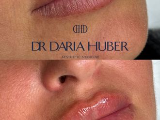 Powiększanie ust kwasem hialuronowym przed i po - 877536