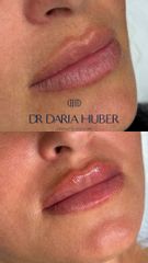 Modelowanie ust kwasem hialuronowym