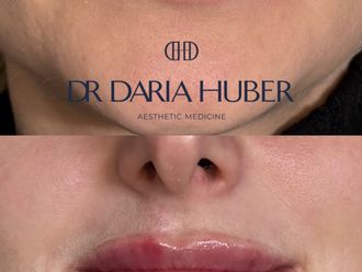 Powiększanie ust przed i po - 877537