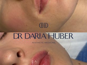 Powiększanie ust przed i po - 877538